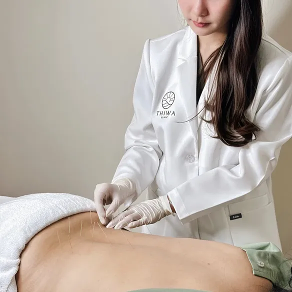 แพทย์แผนจีนกำลังทำการฝังเข็มรักษาคนไข้